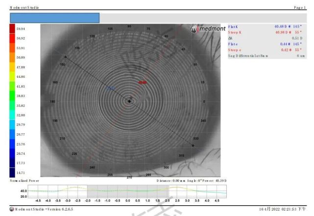 角膜接触镜验配案例图解,戴角膜塑形镜反复出现点染的原因