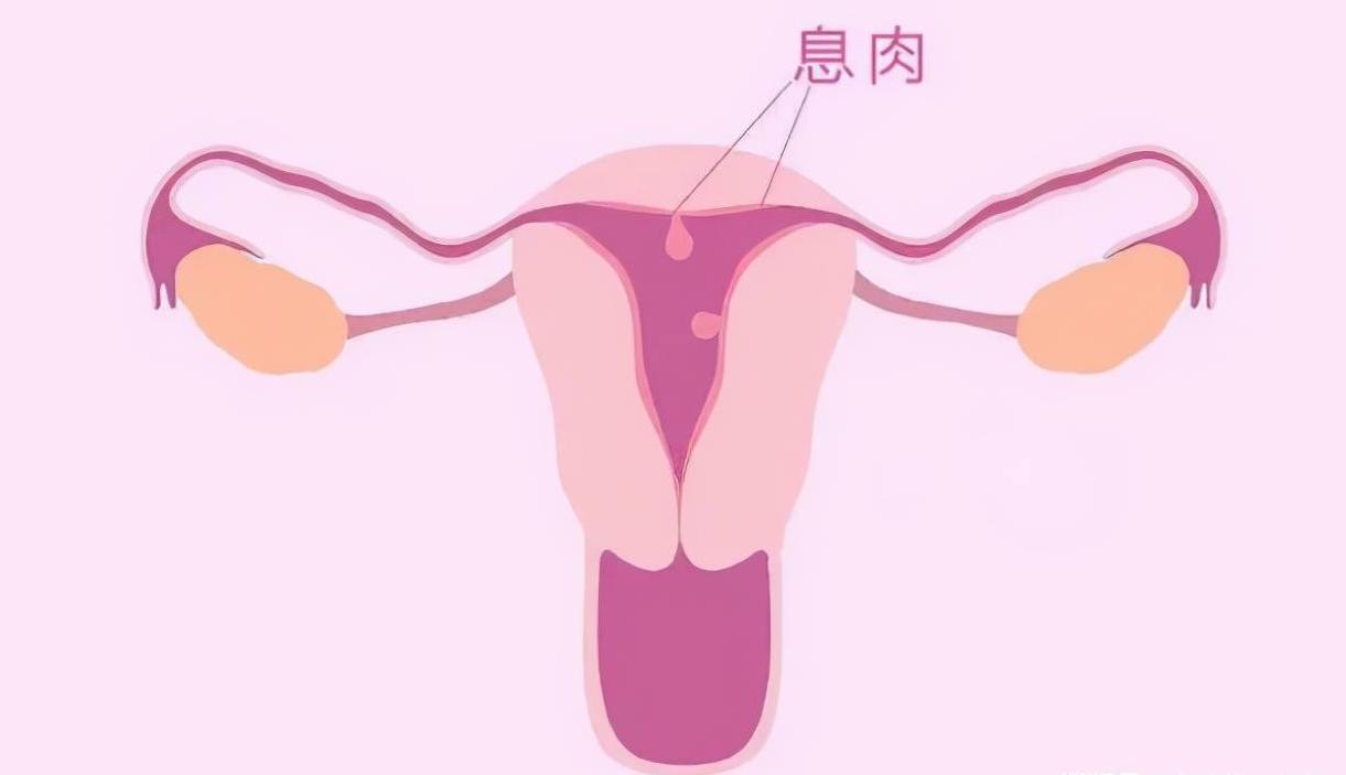 子宫息肉切除了复发要多久,子宫息肉切除后复发怎么办