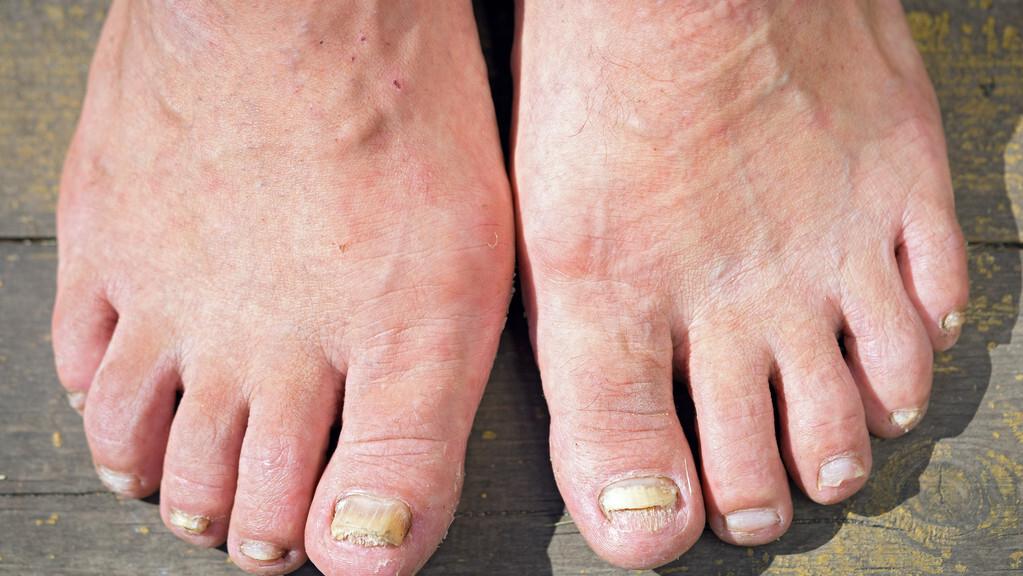 得了灰指甲一个传染俩咋办,得了灰指甲怎么避免一个传染俩