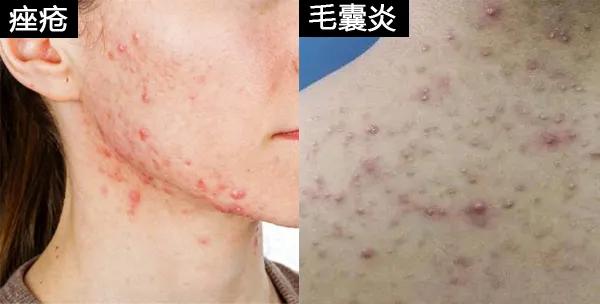 毛囊炎和湿疹的区别,毛囊炎是疮的范畴吗
