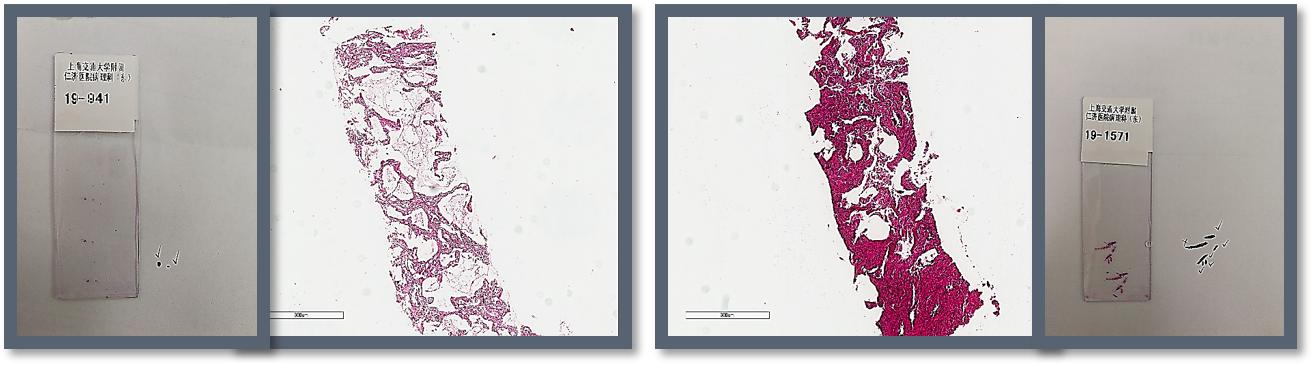 肺高危磨玻璃结节怎么治疗最好,肺磨玻璃结节影微创手术