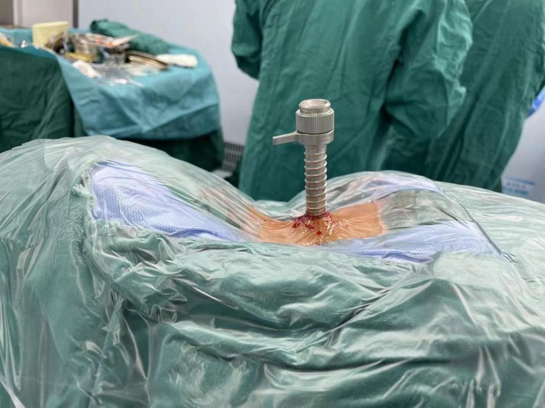 西安椎间孔镜手术治疗颈椎,西安红会医院微创