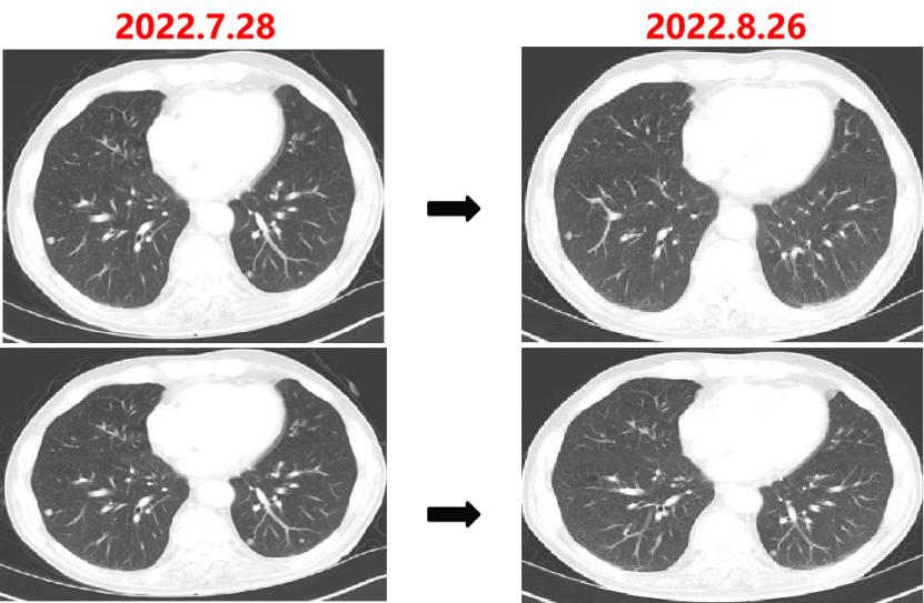 中国国内结直肠癌最新治疗,结直肠癌治好的可能性大吗