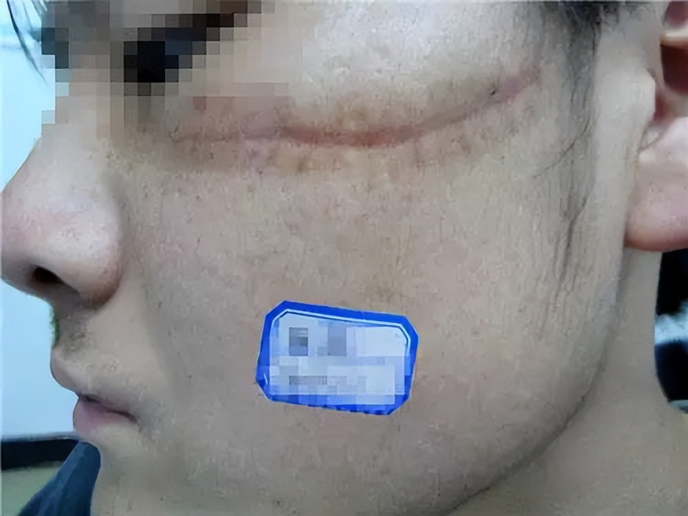 郑州市祛疤痕治疗哪家医院好,郑州市第二中医院祛疤痕怎样