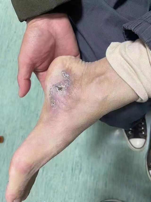 老人脚后跟长黑色素瘤,脚后跟长了一颗恶性黑色素瘤