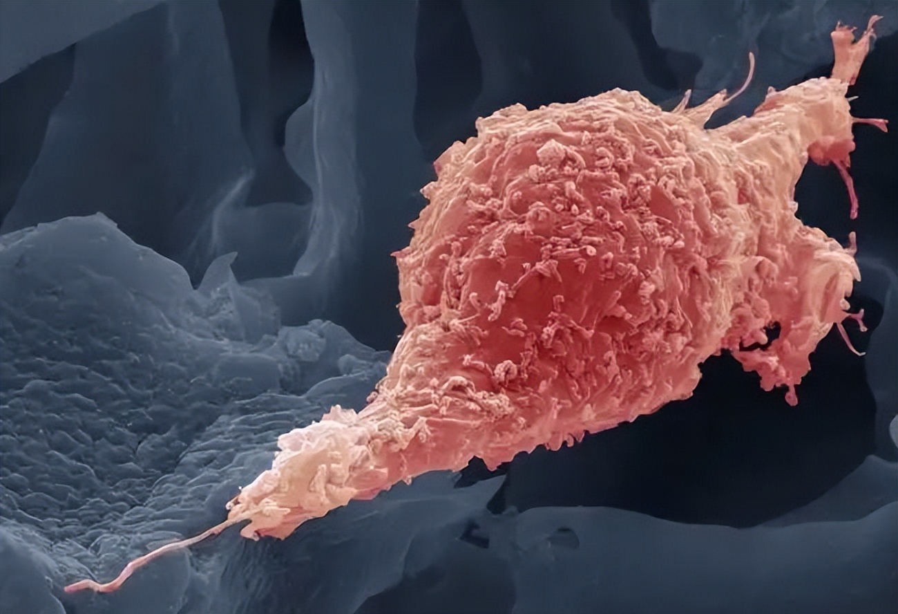 紧急提醒：有人中招查出宫颈癌？身上有一股臭味，不能大意