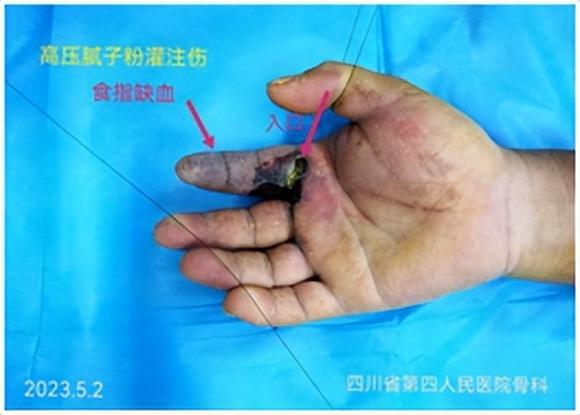 手指被牙签扎了没流血有脓液,手指被扎了一下没有破但是有红点