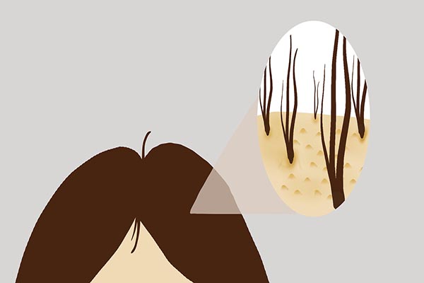 青春期头皮上长红疙瘩有头屑,头屑多头皮有小疙瘩怎么办