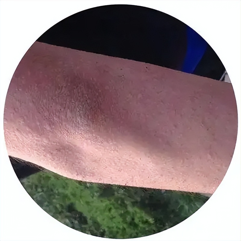 打球身上痒是什么原因,运动后皮肤瘙痒的原因有哪些