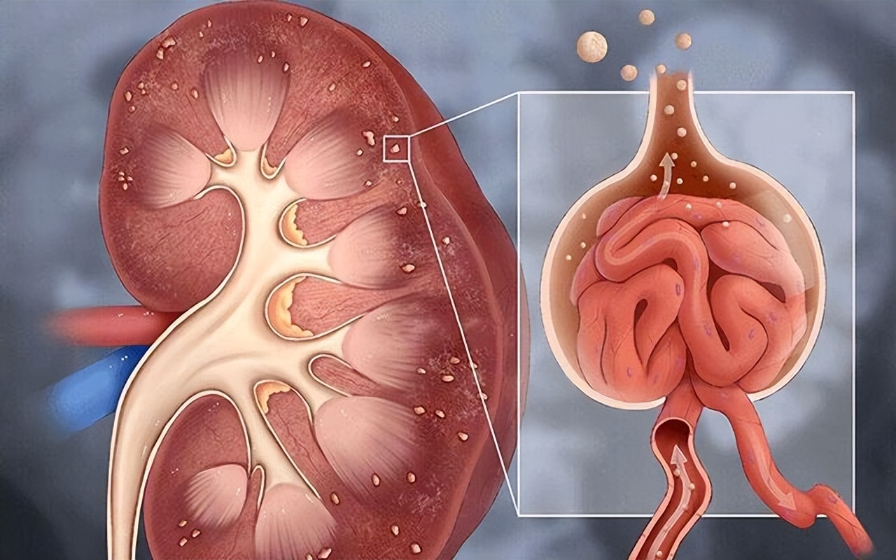 紫癜病友康复历程,紫癜肾炎复发了怎么办