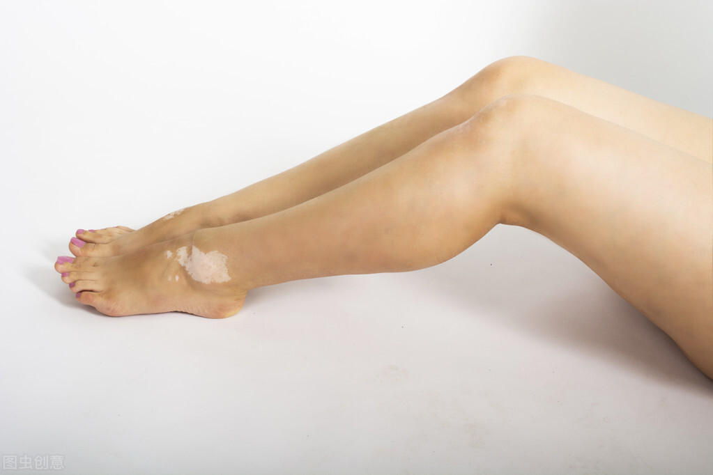 身体出现小白点是什么病,白癜风的位置上慢慢出现小黑点