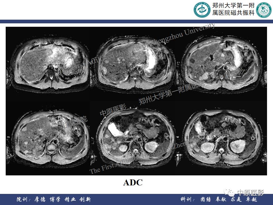 肝脏血管瘤样本,正确认识肝脏血管瘤文章