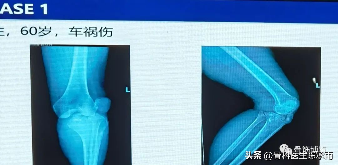 国家卫健委主办的骨创伤专项能力培训项目----下肢损伤学习班