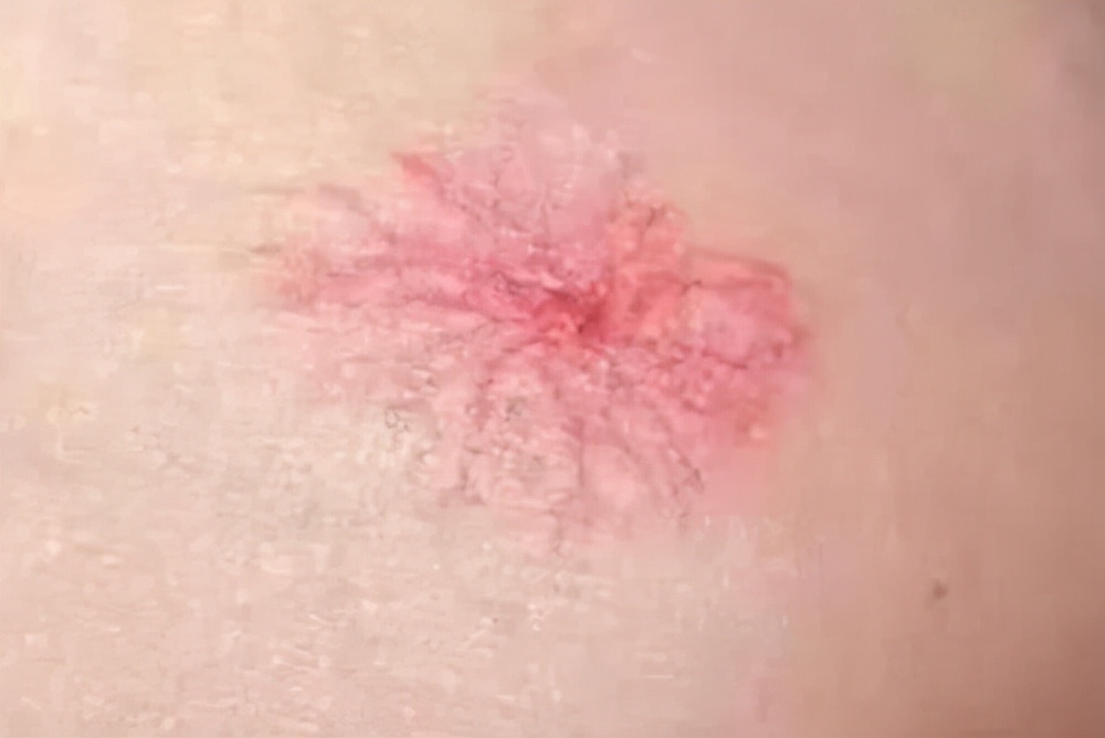 皮肤出现小红点像血点是怎么回事,皮肤上出现了小红点是什么症状
