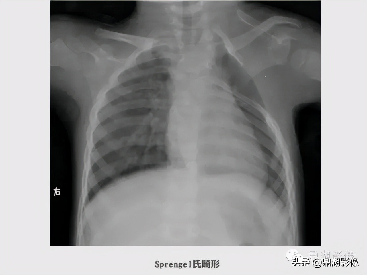先天桡骨缺失畸形能治疗吗,先天性桡骨发育不良
