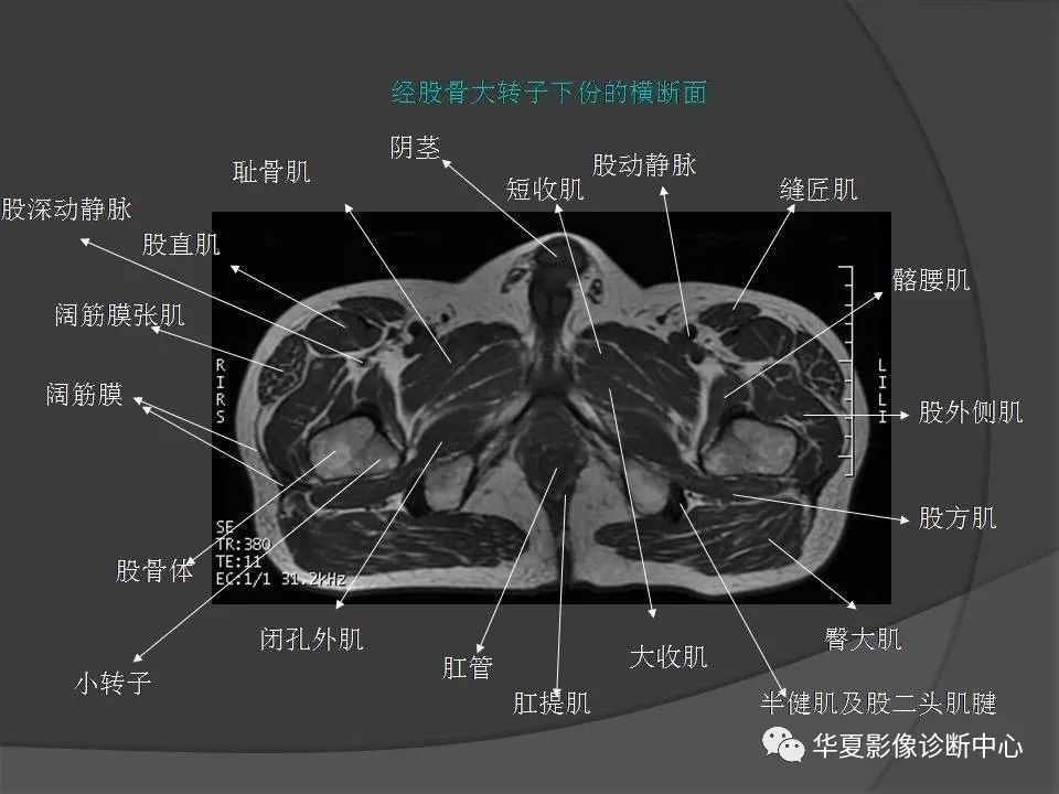 女性盆腔ct连续断层解剖图,盆腔mri影像病例分析
