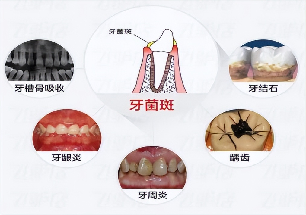 牙菌斑知多少,怎么去牙菌斑