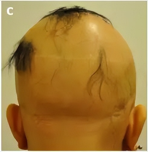 秃头康复,秃头可通过头疗生发吗