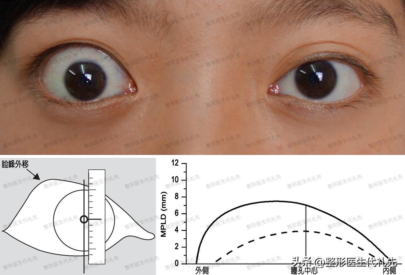 眼球鼓做全切双眼皮,全切双眼皮缝合位置有凸起小疙瘩