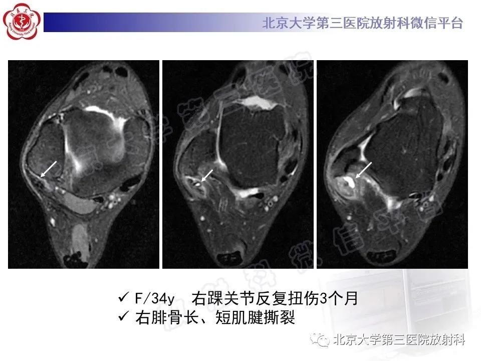 好文分享续集,腓骨肌腱脱位手术价格