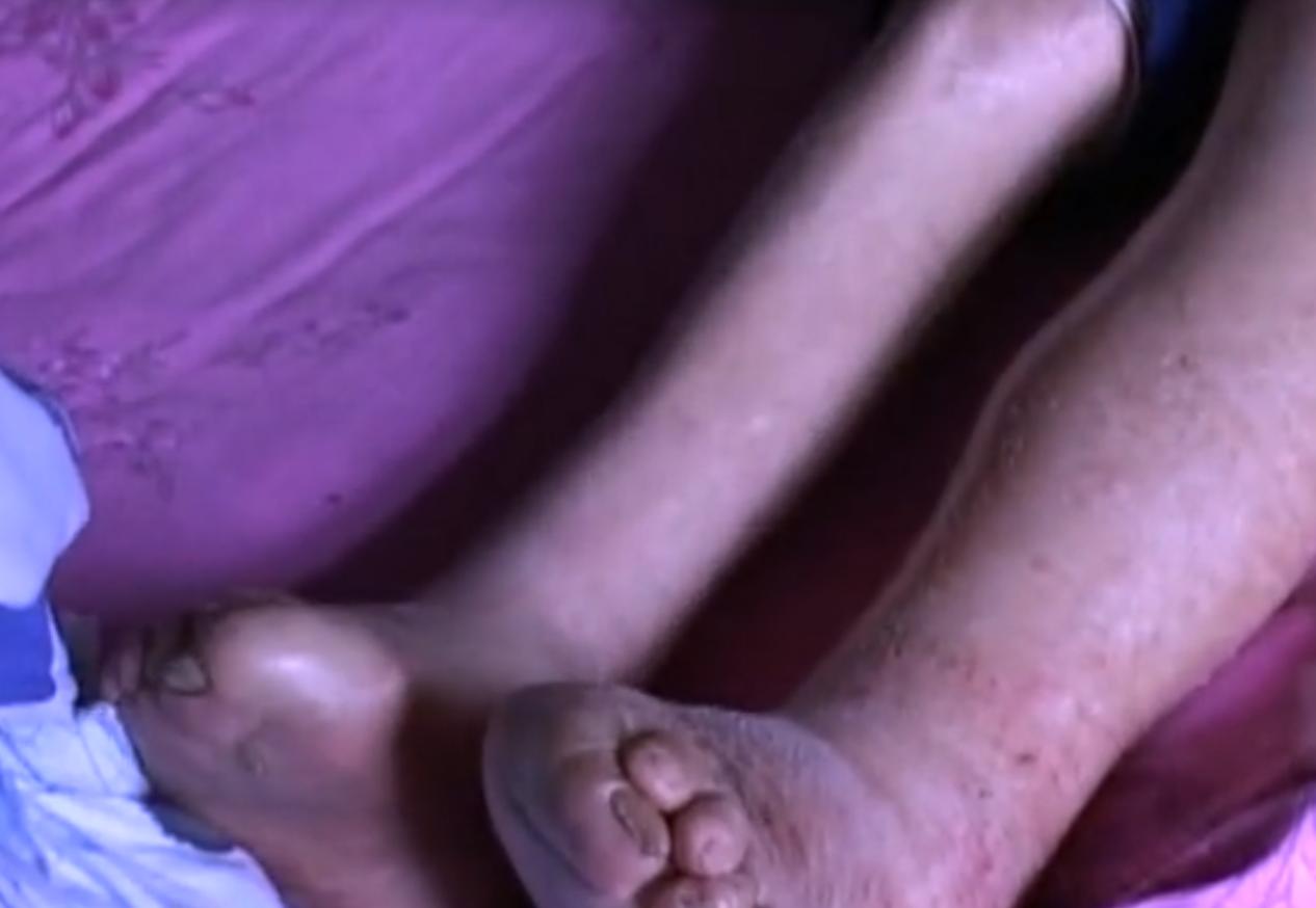 2007年四川90岁老妇，腹中怀子60年未生，后检查发现胎儿没有腐烂