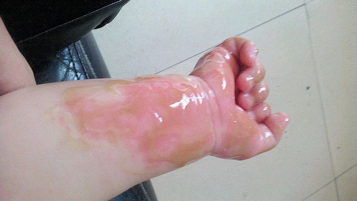 如果孩子被烫伤怎么正确处理,小孩被开水烫伤怎么处理好