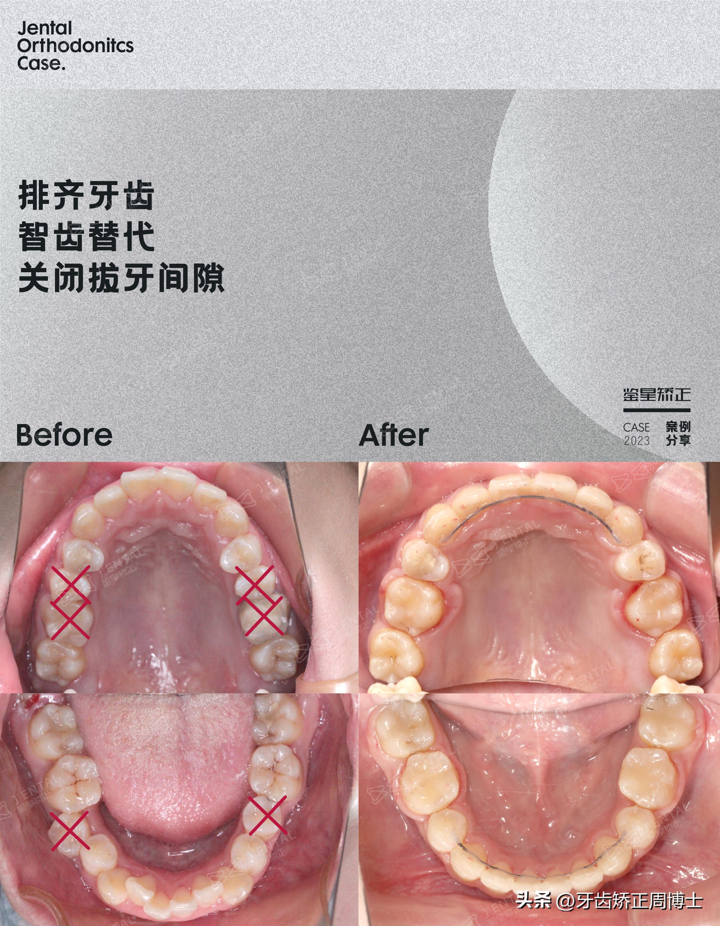 龅牙骨钉矫正演示,骨性龅牙打骨钉前后对比