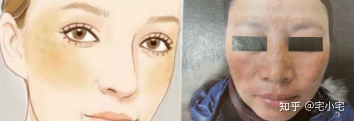 美白淡斑和美白祛斑有什么区别吗,美白和祛斑的区别