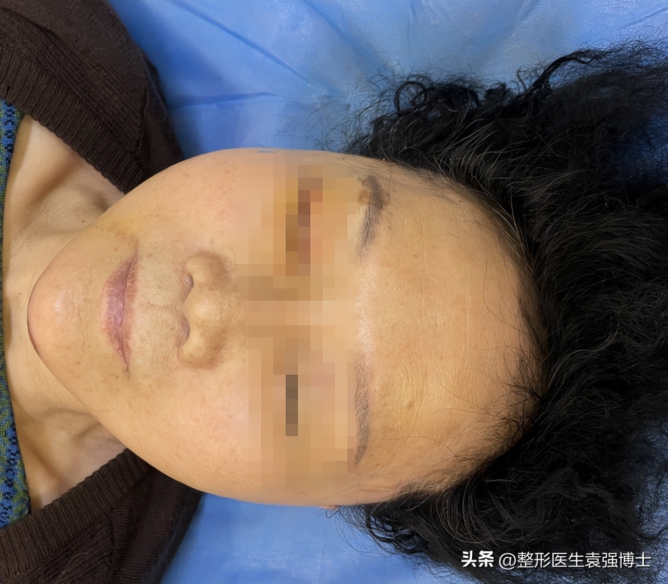 71岁不怕切口长，直接做了大拉皮，第7天拍照看，没敢认啊