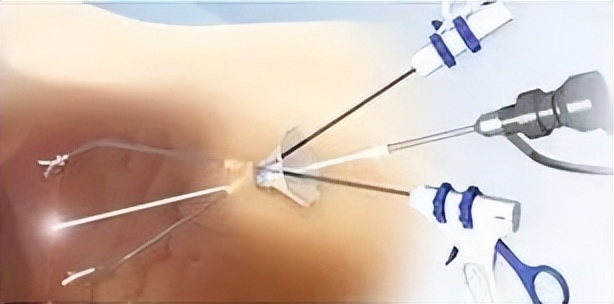 这种方式的腹腔镜手术，真正实现腹部“零瘢痕”