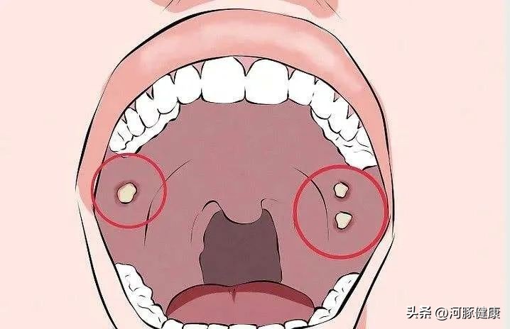 长期口腔溃疡不疼不痒,长期口腔溃疡不愈合会怎样