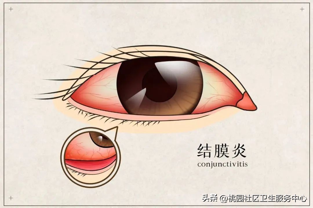 红眼病一看就感染吗,红眼病看一眼会怎么样