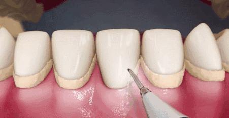 牙齿发黄怎么办快速解决方法,牙齿发黄怎么办最快最有效方法