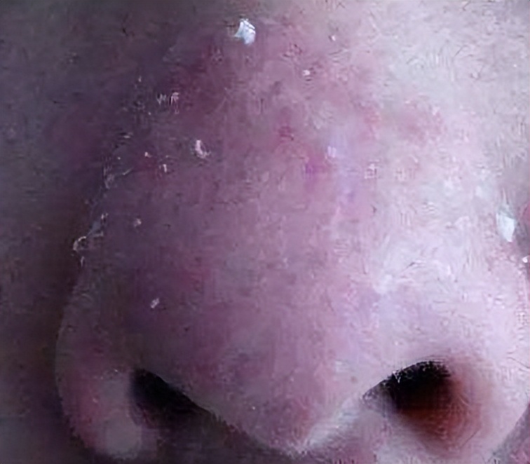 清洁面膜可以去黑头粉刺闭口吗,清洁面膜可以去除黑头吗