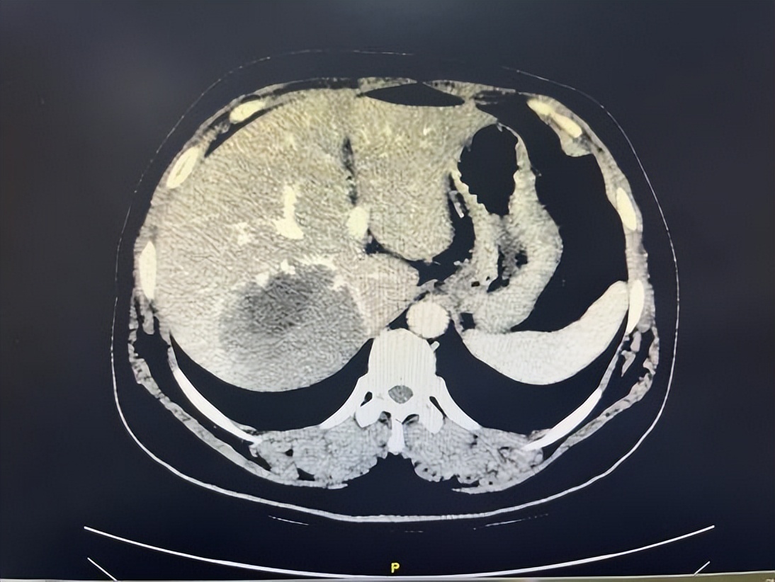 哈医大一院做脑血管瘤,哈医大一院肝脏微创外科