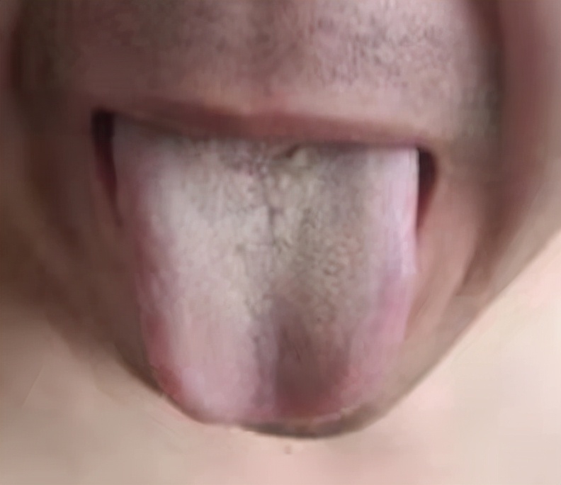 脂溢性脱发治疗第一个月效果,治疗脂溢性脱发最有效的方法