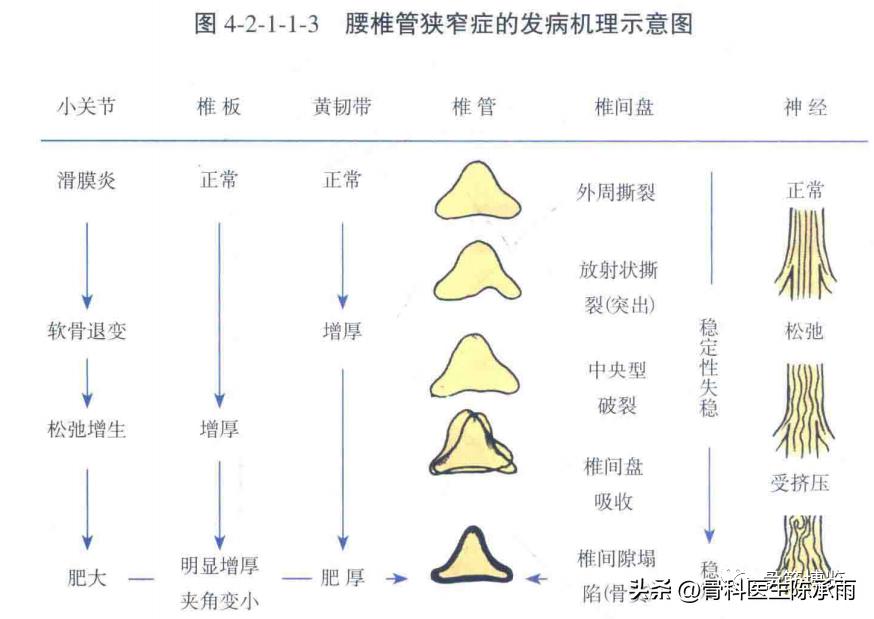 腰椎滑脱椎管狭窄手术后遗症,腰椎间盘突出椎管狭窄的手术