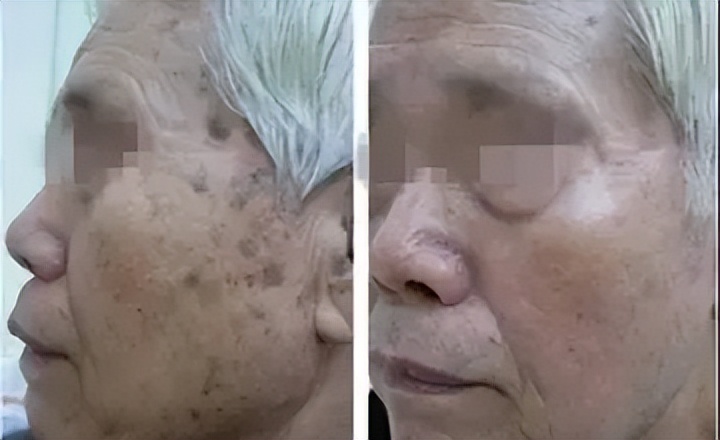 老年斑和色素沉着怎么治,老年人色素沉着怎么去除