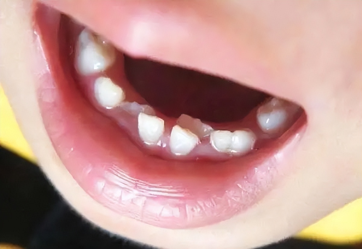 后槽牙换牙过早怎样抑制新牙生长,换牙期新牙长出来了旧牙不掉