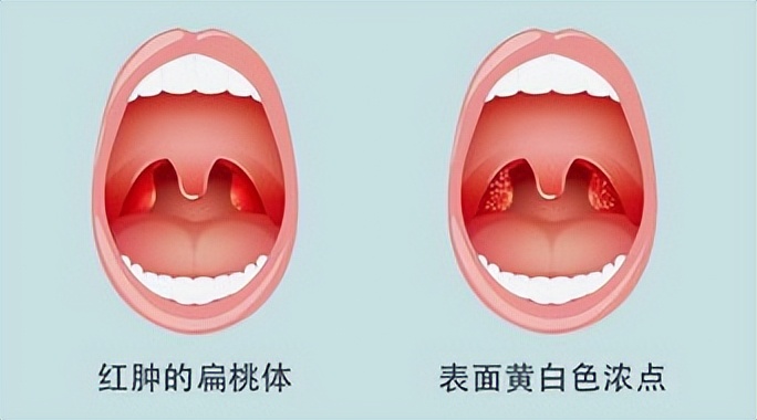 扁桃体炎是不是很严重,扁桃体炎就是感冒吗