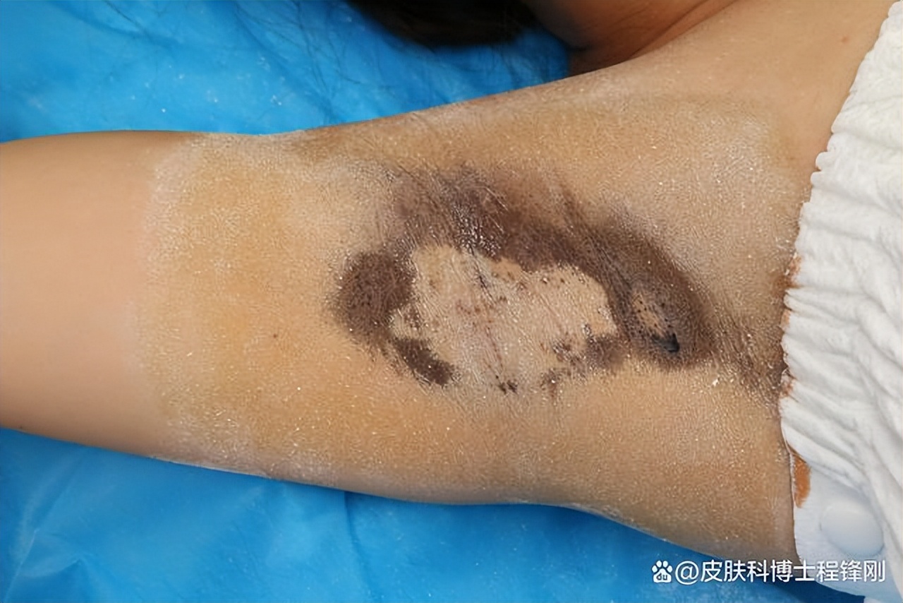 狐臭微创手术伤口流脓有臭味,狐臭微创3年后复发怎么办