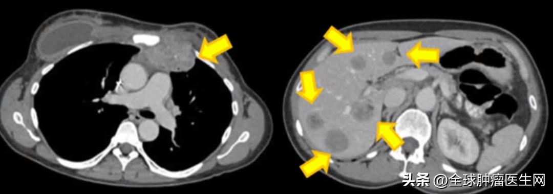 晚期乳腺癌成功抗癌的案例,乳腺癌免疫治疗晚期癌症的治愈率
