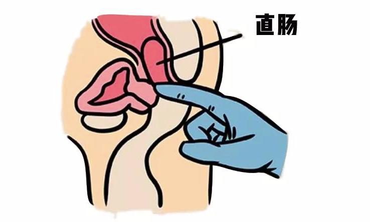 肛门附近的癌症症状,体内有癌大便先知