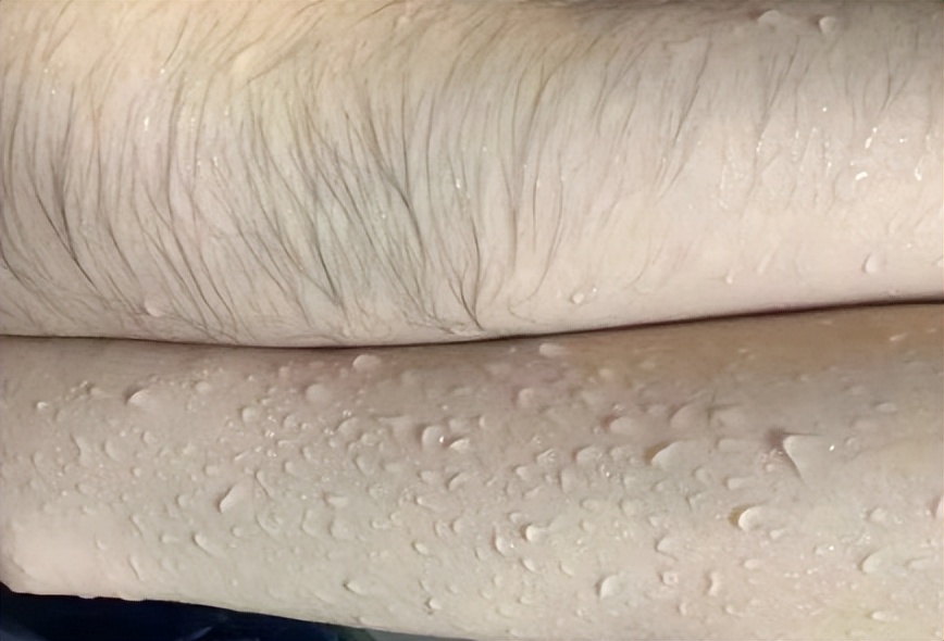 脱毛全攻略｜夏日不脱毛，人间猕猴桃