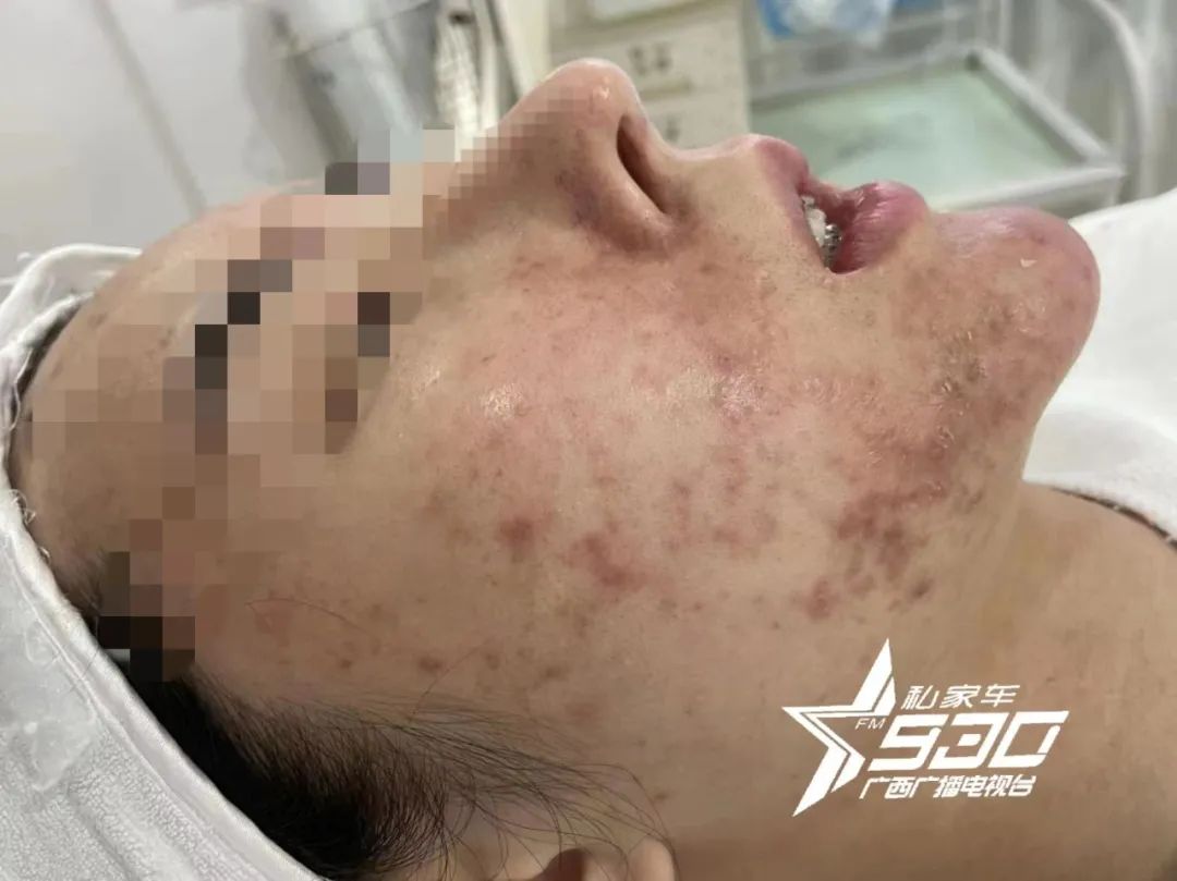 南宁市三甲医院祛痘印痘坑,南宁祛痘祛痘坑