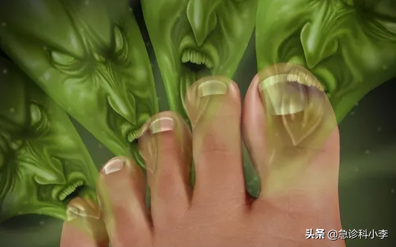 脚气反反复复怎么办？医生：教你2个实用方法，根治脚气不复发