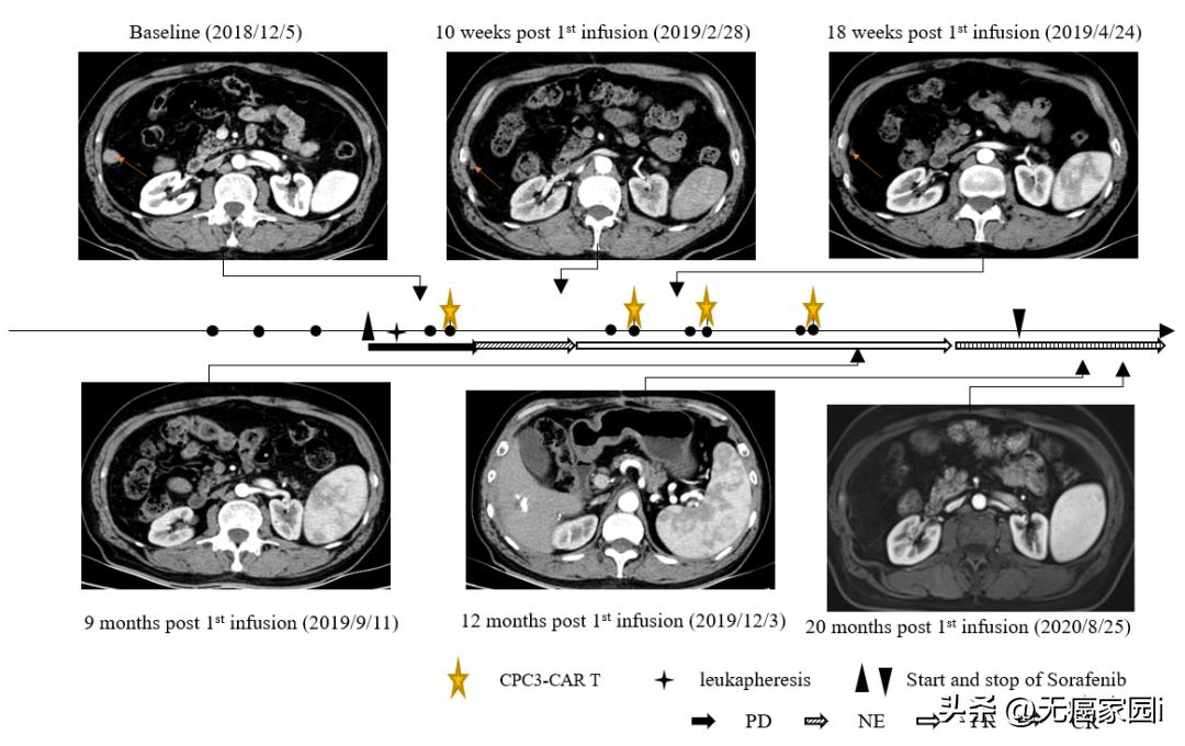 CAR-T疗法全球首例,car-t疗法和nk疗法