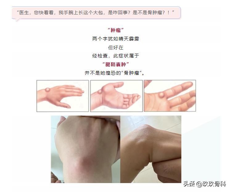 手腕骨肿瘤良性的多还是恶性的,手腕恶性骨肿瘤症状