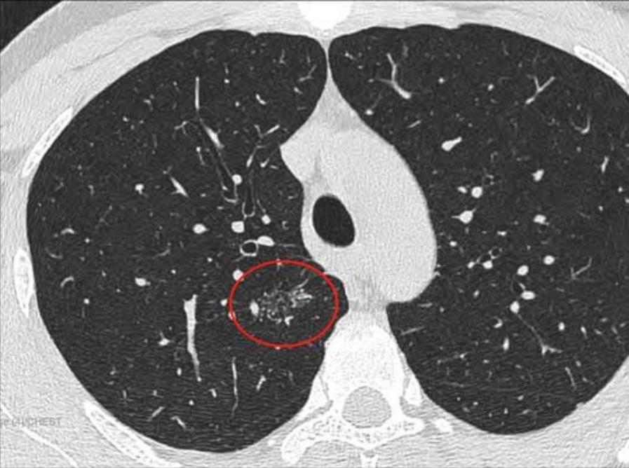磨玻璃结节9*8mm建议随访,8mm磨玻璃结节一年没长