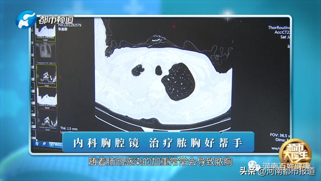 胸腔镜下左侧脓胸廓清术,内科胸腔镜治疗脓胸